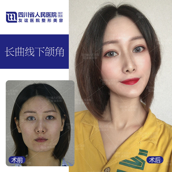 整形界的医生,达人,美女们,帮我看看_新氧-专业医美