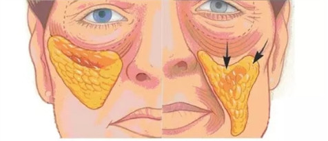 颊脂垫的皮肤松弛下垂