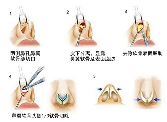 对于左右两侧壁顶点距离大的,可以采用缝合固定两侧鼻翼软骨的方法