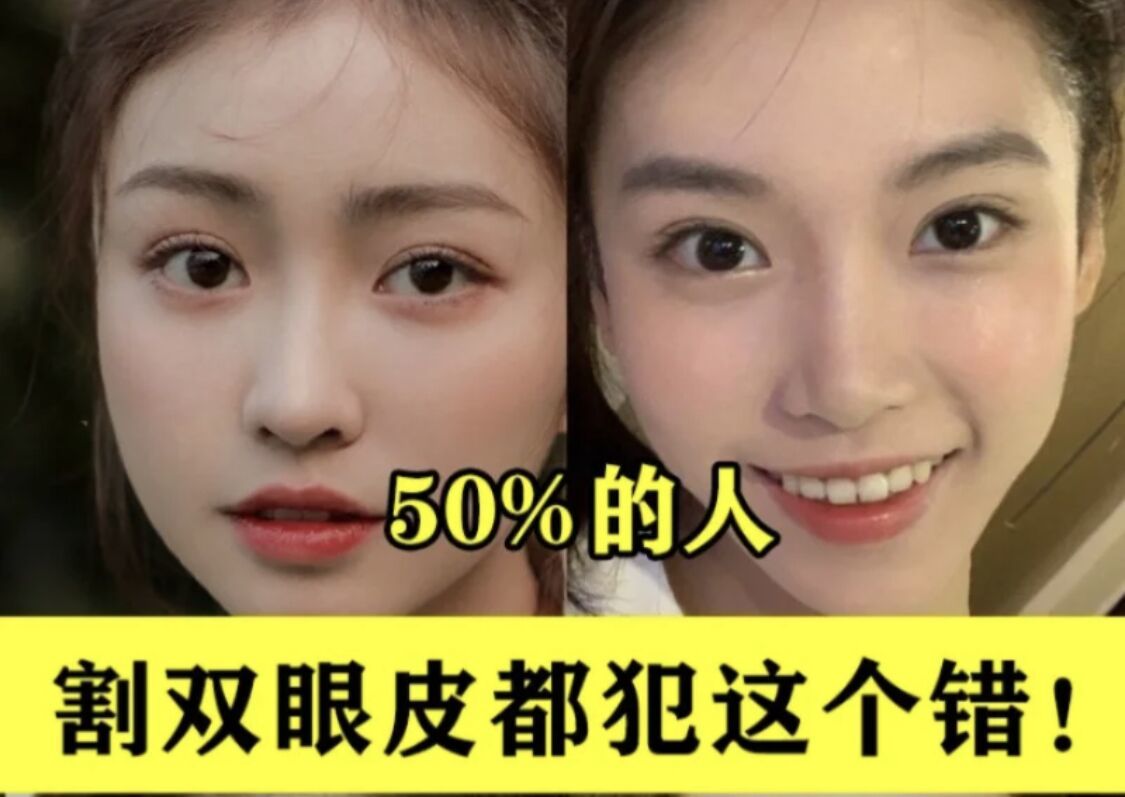 武汉美基元割双眼皮避雷必看功课