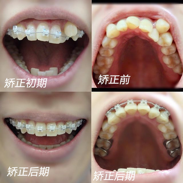 案例分享虎牙外凸牙齿错乱不齐大龄矫正