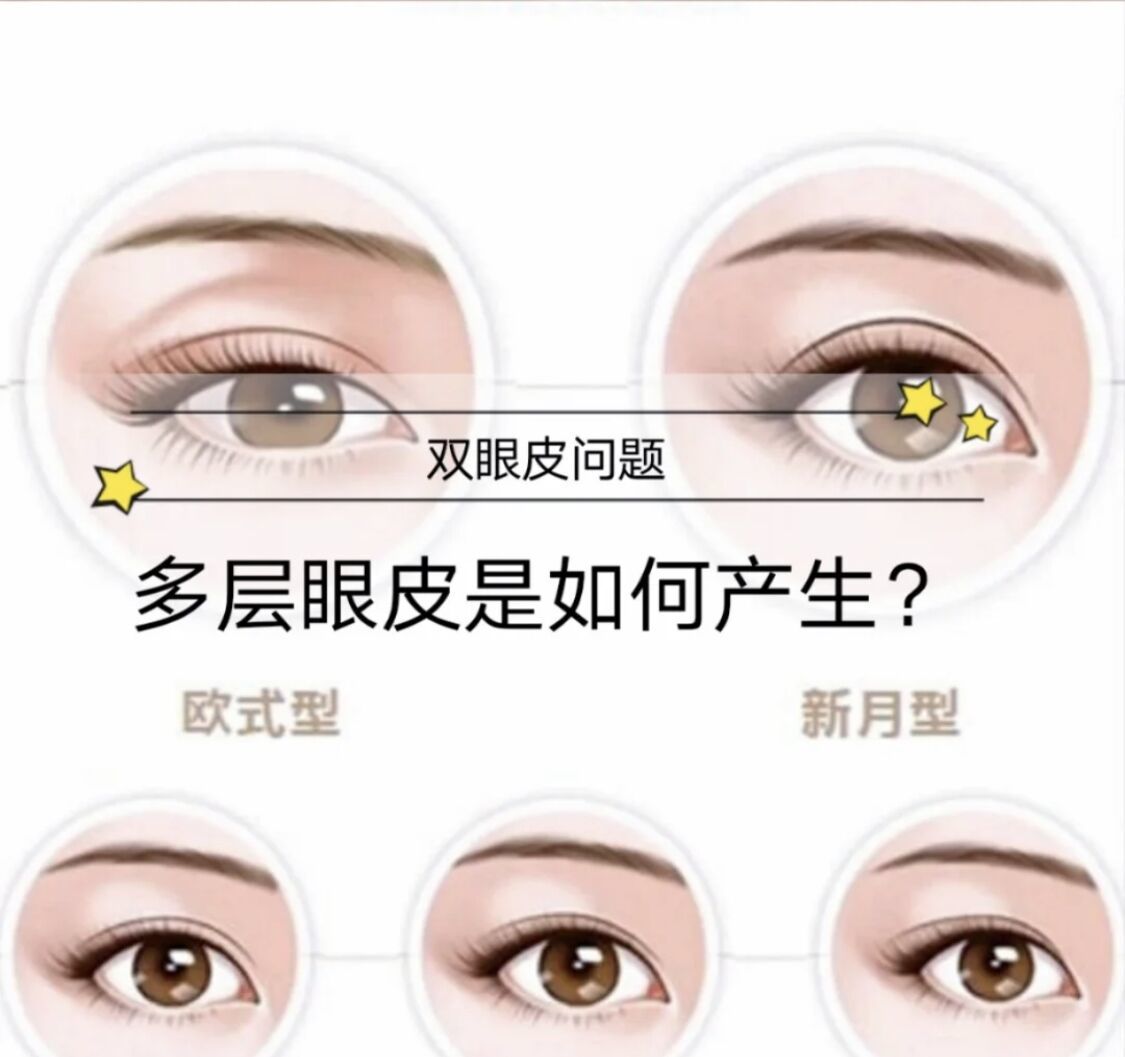 【武汉美基元】多层眼皮是如何产生?