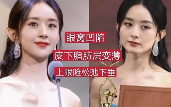 眼窝凹陷偏爱大眼美女真相是