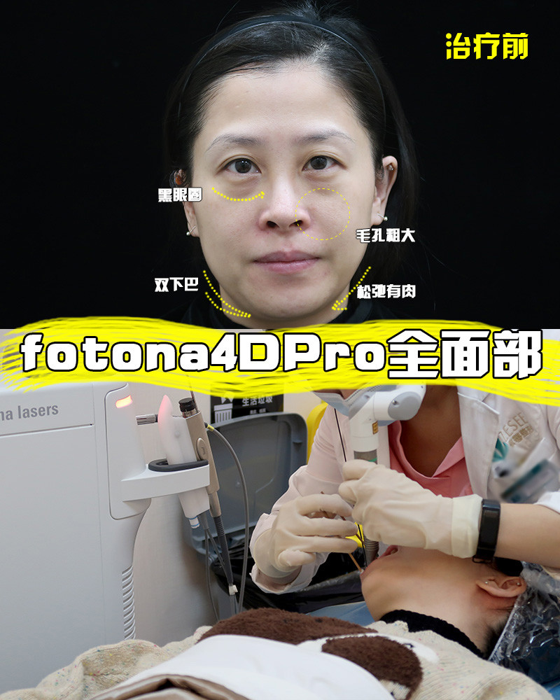 fotona4dpro全面部治疗恢复第12天啦