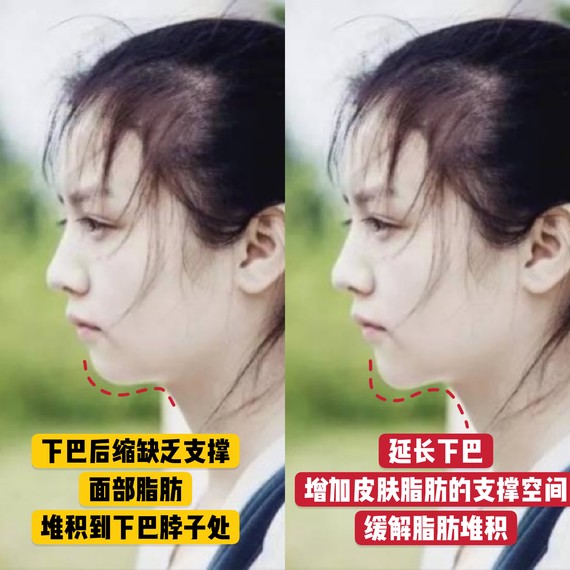 面部软组织会下垂堆积到脖子间,形成双下巴
