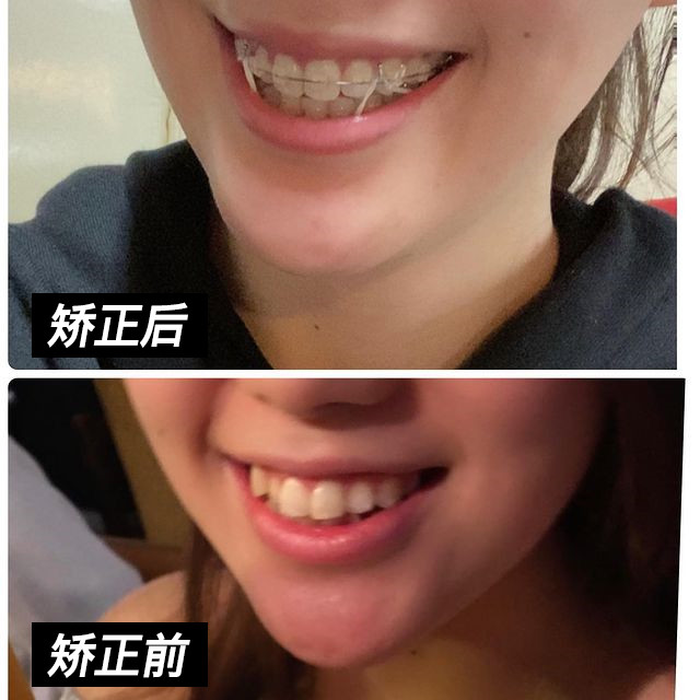 很多人矫正都是因为牙齿不整齐,牙凸之类的原因,但是牙凸和不整齐也