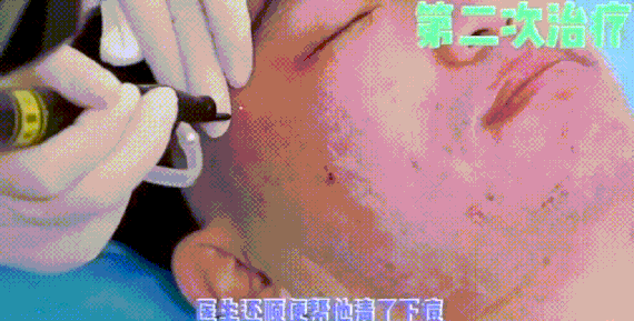 做完以后会起一些白色的小粉刺,不过没关系,3~4天就下去了.