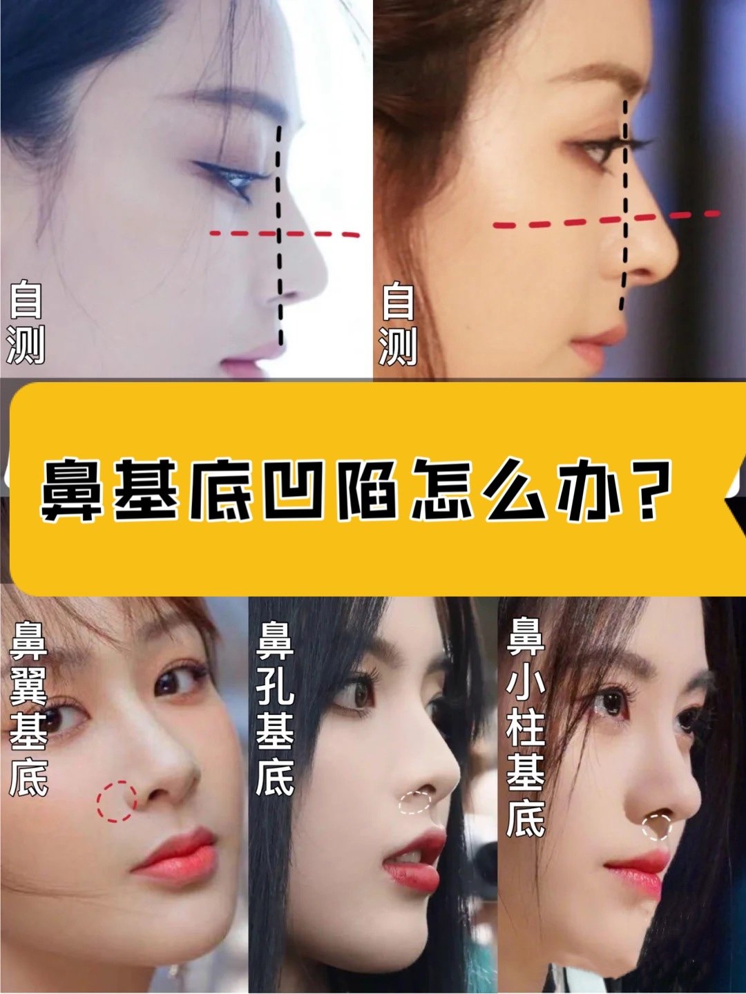 鼻基底是鼻子与上唇相连的基底部分,共有三个区域:①鼻小柱基底;②