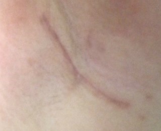 缩胸手术疤痕图片