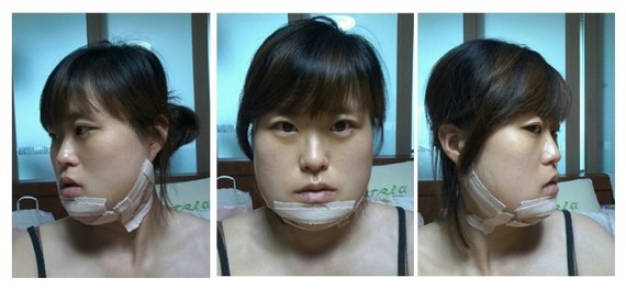 棱角下巴矫正 下颚内缩1个月后