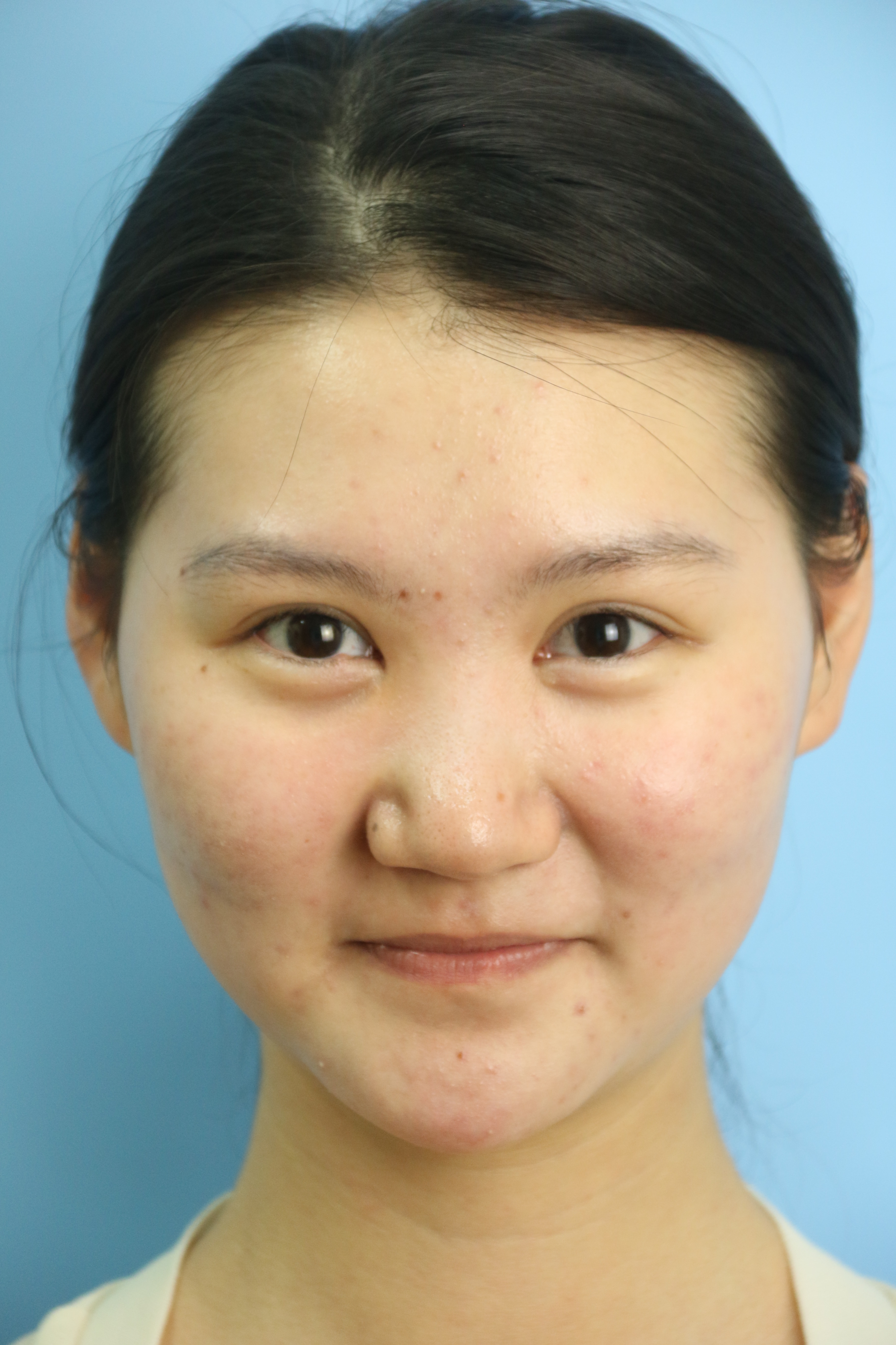 before 1 after 1 患者23岁,先天性低鼻,近五年来觉得鼻背及鼻尖低