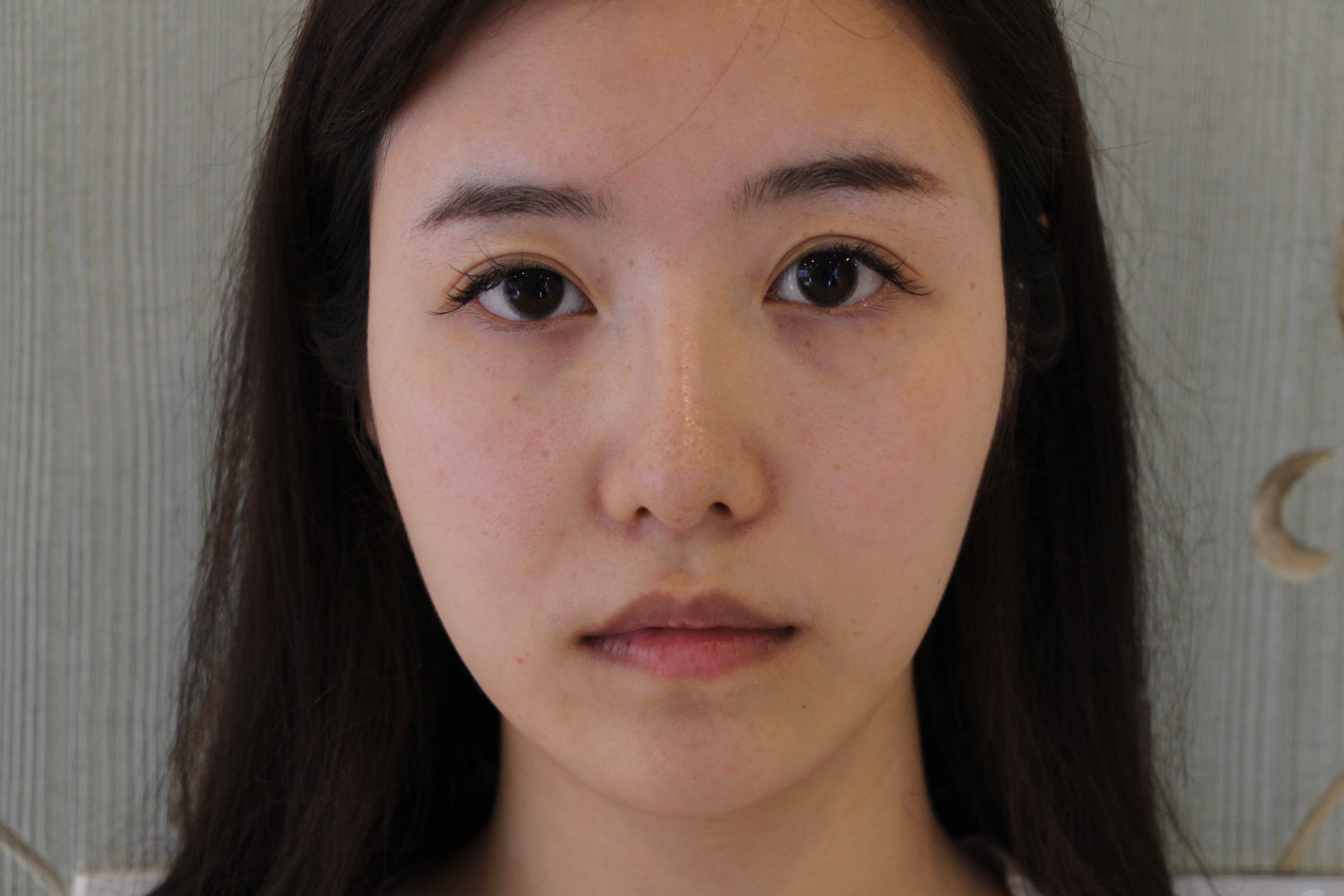 患者术前面部诊断报告:  上唇唇峰唇珠不明显,唇线模糊,嘴角平乏,整个