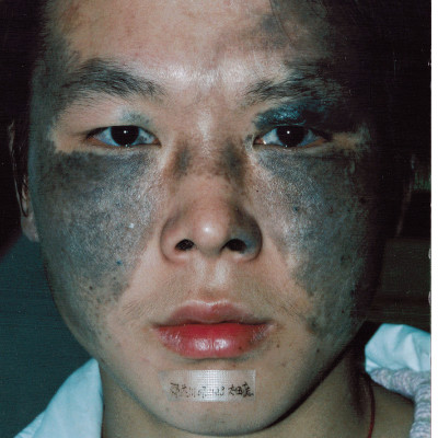 手术时长        报告亮点 胎记治愈,太田痣治疗 主诉 出生便