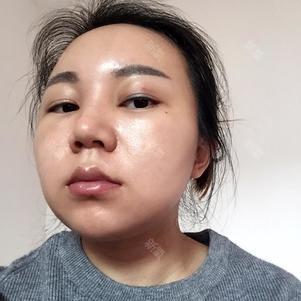 想变小又饱满的脸的美丽日记"11.25"自体脂肪垫下巴