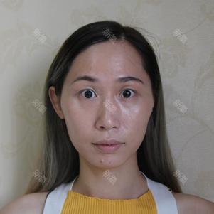 【玻尿酸】艾莉薇 艾莉薇 1ml ,艾莉薇单相玻尿酸 原装正品,院长亲诊