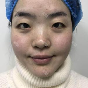 美白针好不好_效果图_氧气hbs3e94美白针术后第181天_新氧美容整形