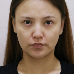 埋线提升好不好_效果图_李小丽最美埋线提升术后第297天_新氧美容整形