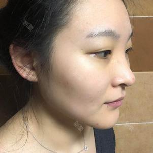 【青岛伊美尔5s重睑术 超微创开内眼角 祛眼袋术后_圈子-新氧美容整形