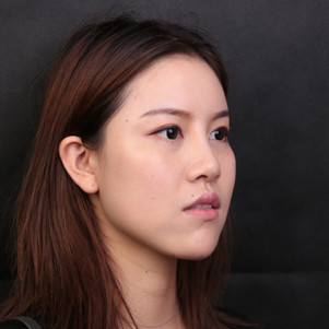 【达拉斯隆鼻术后26天】【隆下巴术后26天】