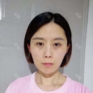 【青岛伊美尔5s重睑术 超微创开内眼角 祛眼袋术后_圈子-新氧美容整形