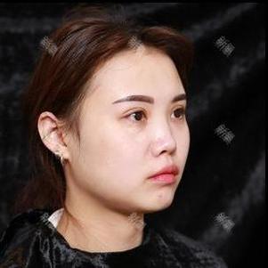 温州美域高医疗美容玻尿酸隆鼻怎么样_恢复过程_效果如何_氧气31u4a