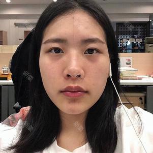 【光子嫩肤】7月特惠【aopt王者之冠】正版官方认证m22 淡斑去红血丝
