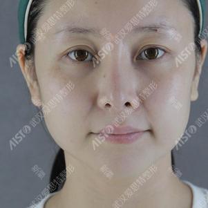 【武汉爱思特·耳软骨鼻尖 鼻头缩小 缩垫鼻背·术后_圈子-新氧美容