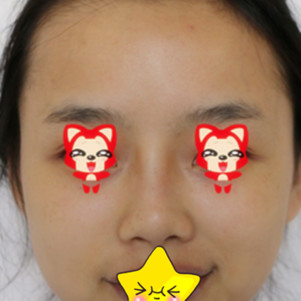 鼻综合怎么样_恢复过程_效果如何_sunnygirl艾琳整形日记8.