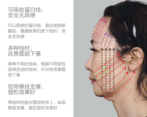 【埋线提升】{线雕专利}【额头小v线抗衰】①6d线雕面部提升②30余年