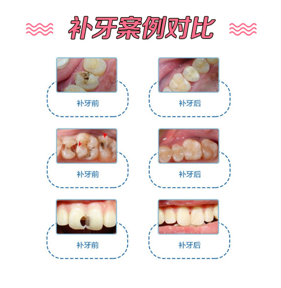 【补牙】成人补牙仅188元/颗 修复蛀牙,虫牙,龋齿,牙齿缺损,持久耐磨
