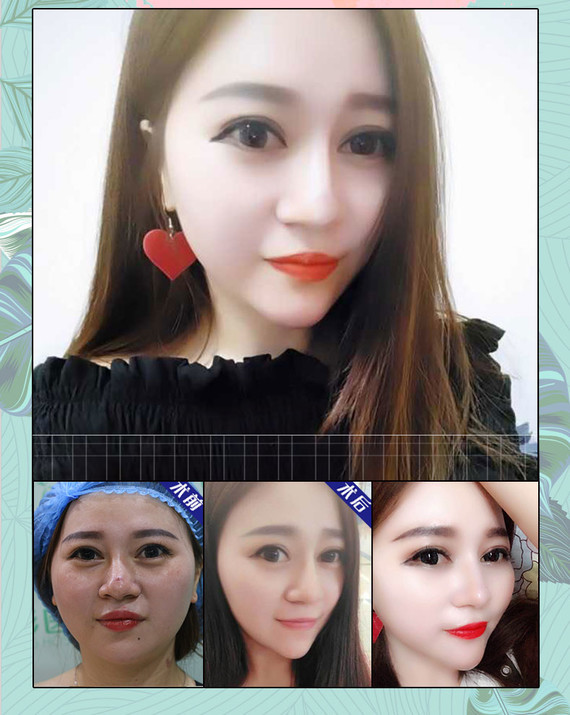 【除皱瘦脸】【除皱瘦脸瘦脸针】瘦脸针 衡力100单位/单支 打造无咬肌