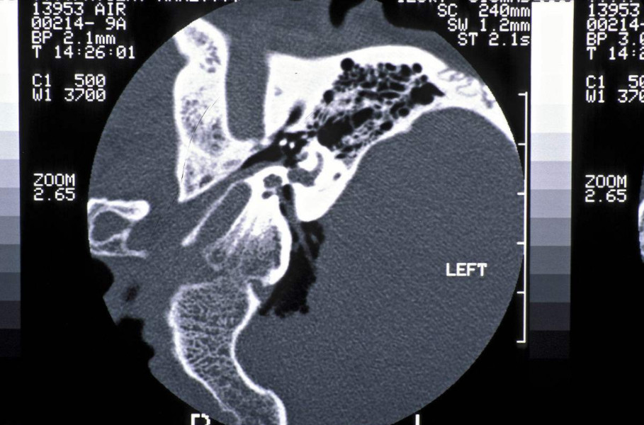 中耳炎ct影像表现图片图片