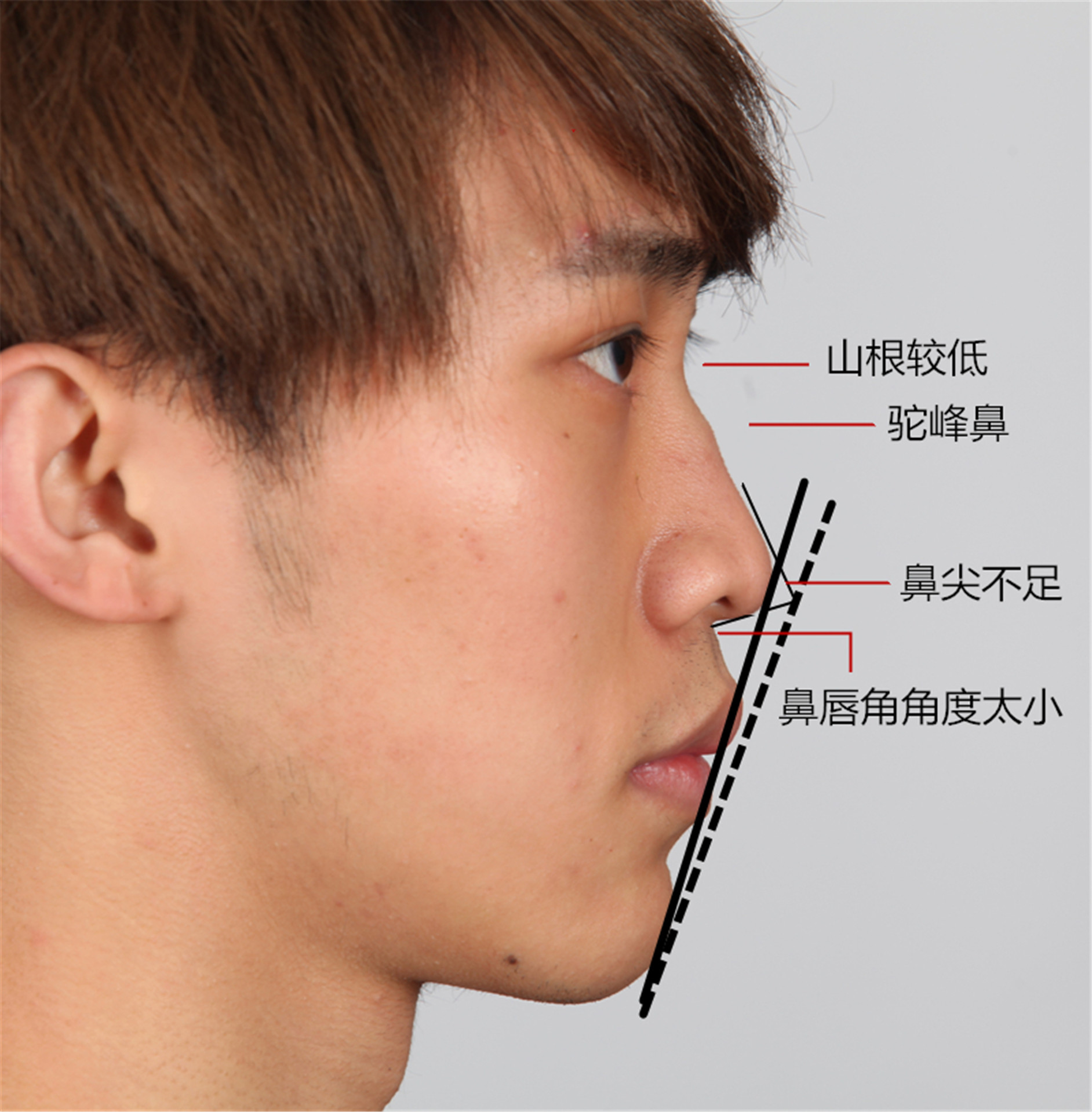 2cm,软骨量优秀 2,鼻唇角:呈锐角75°,远小于9