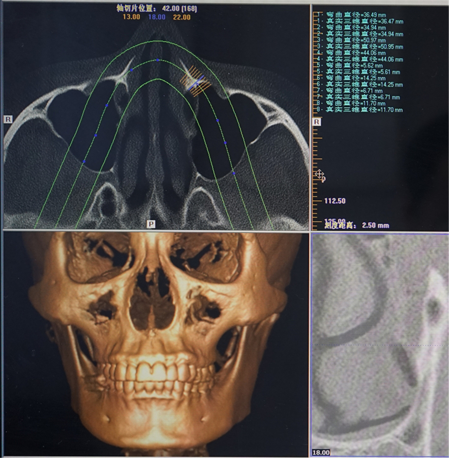 2,ct检测颧骨颧弓: 左侧颧骨弓标宽5564mm 右侧颧骨弓标宽53