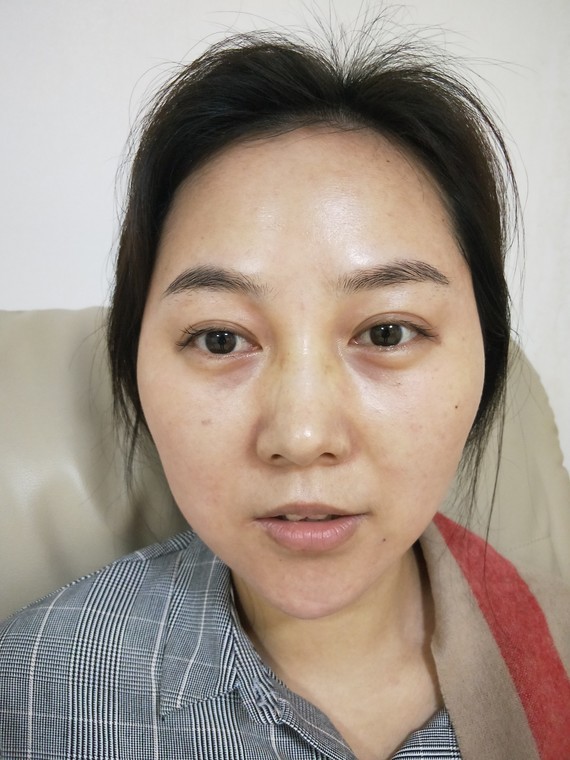 诊断照片术前分析:通过正面照片来看,患者面部轮廓不清晰,脸颊两侧