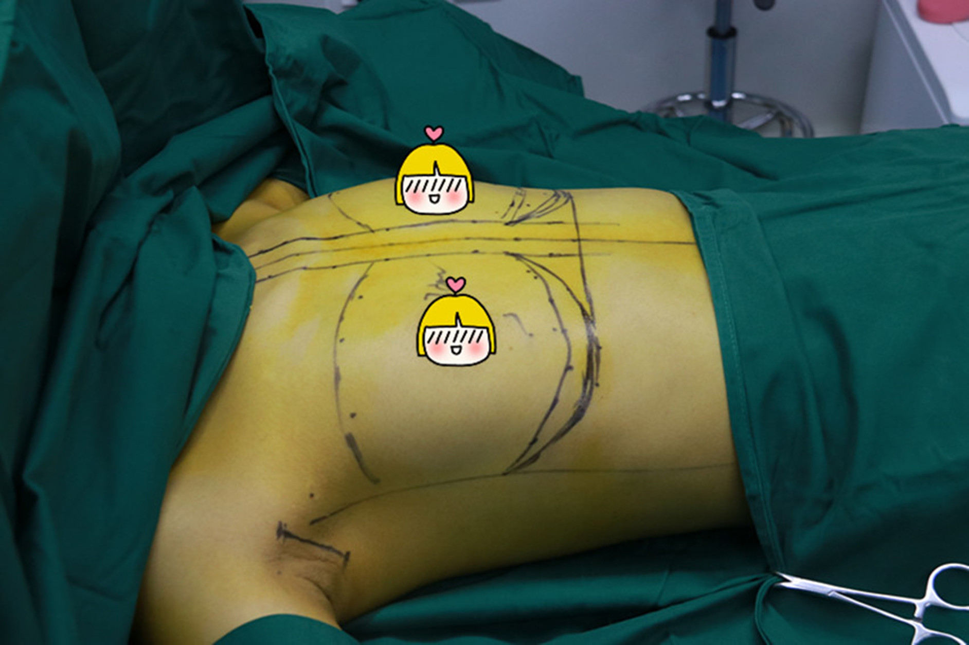 一,手术方案规划和说明: 1,假体放置层次:胸大肌下; 2,切口:腋窝切口