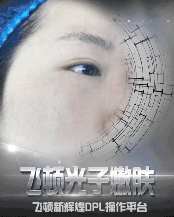 【光子嫩肤】以色列飞顿新辉煌dpl光子嫩肤全脸单次体验 收缩毛孔/祛