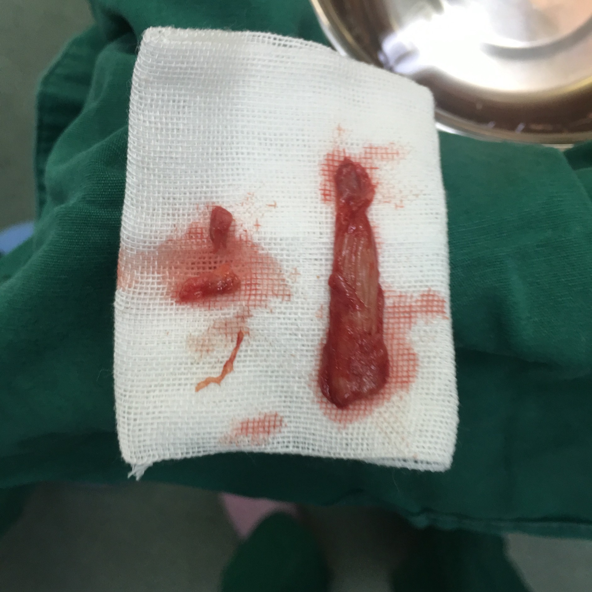 六,手术记录照片: 方案设计: 假体雕刻: 术后即刻: 本次手术采用的是