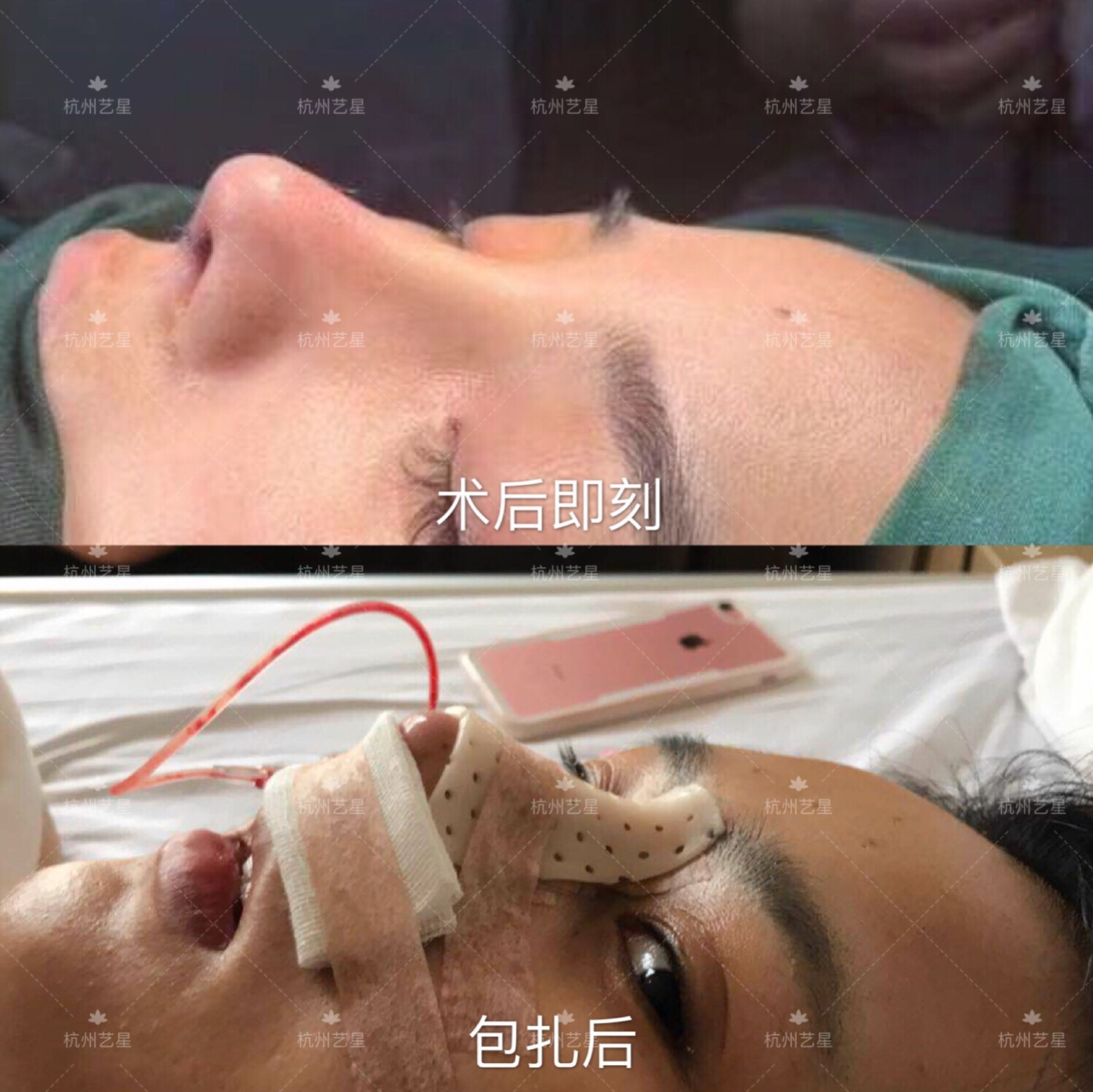 上植于鼻小柱中隔软骨左右侧,双大翼穹窿部前端,5/0可吸收线缝合固定