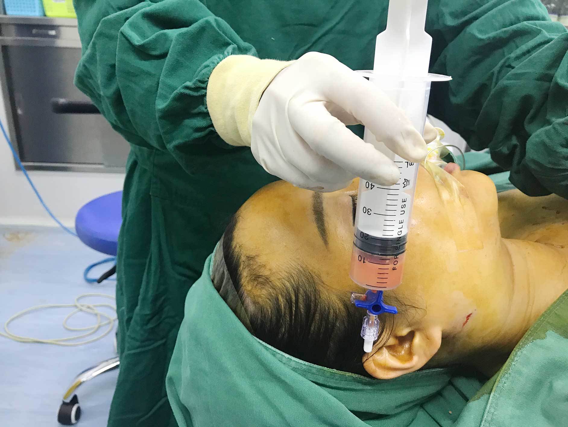 雕刻假体符合顾客自身需求,更美观符合个人气质   4, 局部浸润麻醉,沿