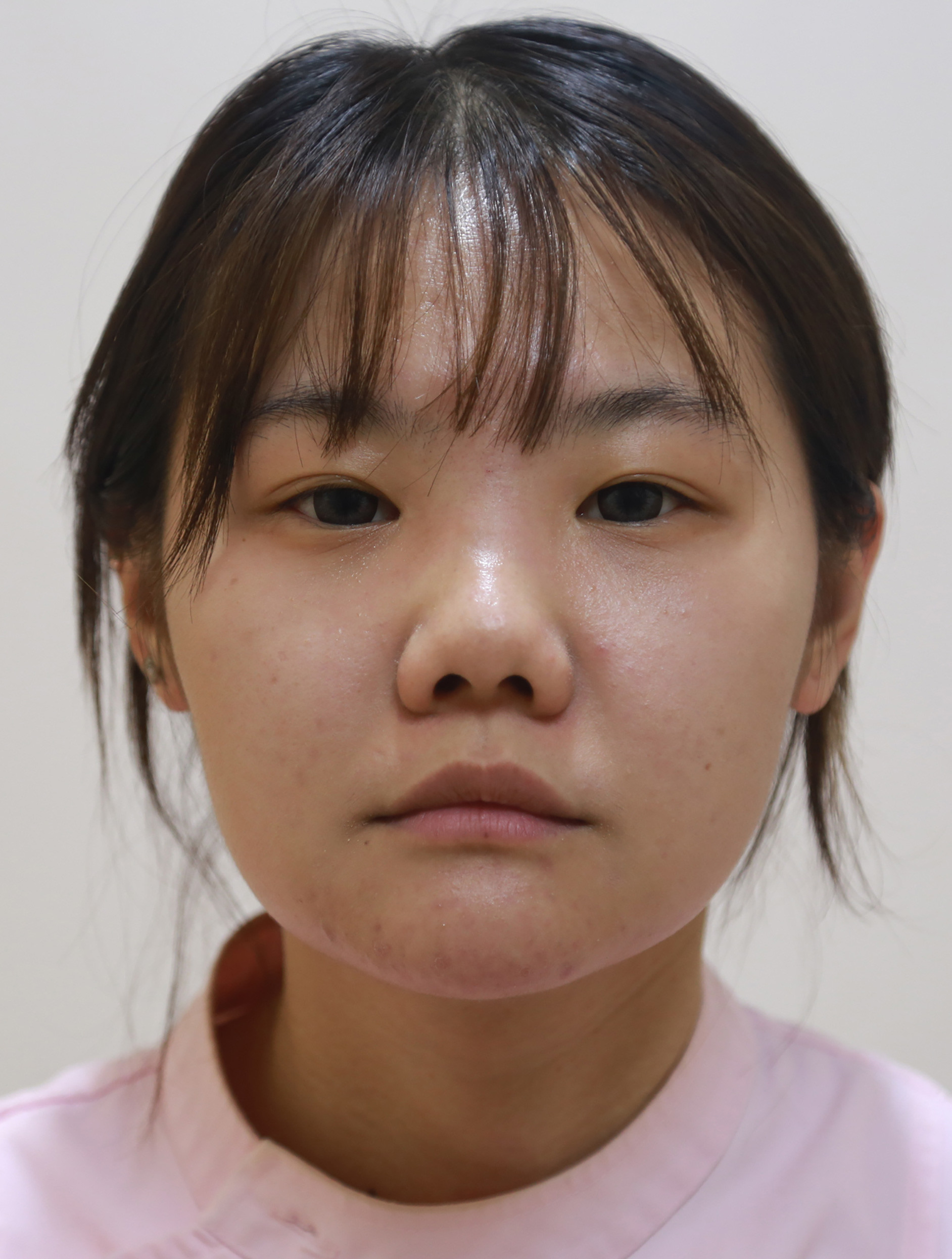 一,患者术前术后对比图