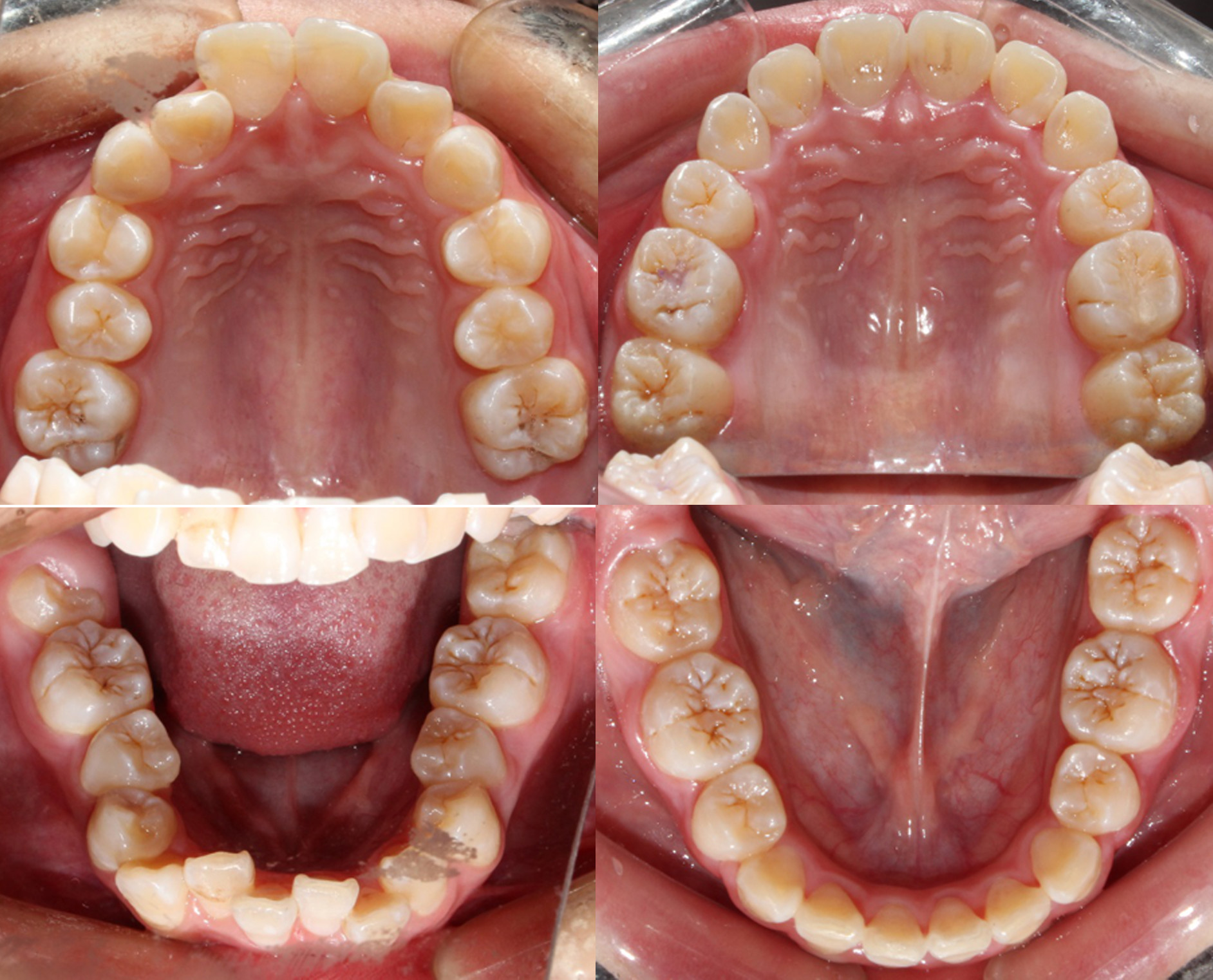 上排术前:牙齿拥挤,后牙咬合关系不佳 矫治通过减数4颗双尖牙,解除牙