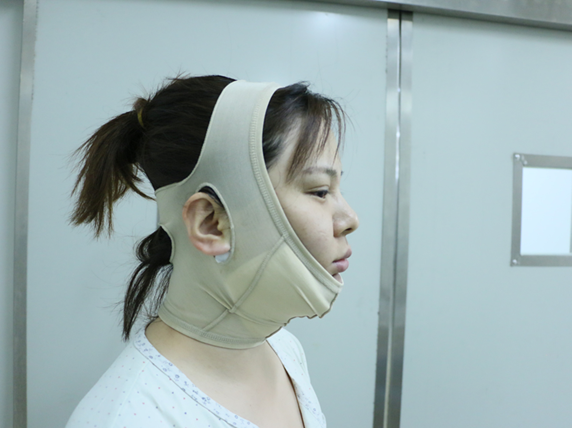 术后缝合包扎,外敷纱布加压包扎. 5.半小时留院观察,无特