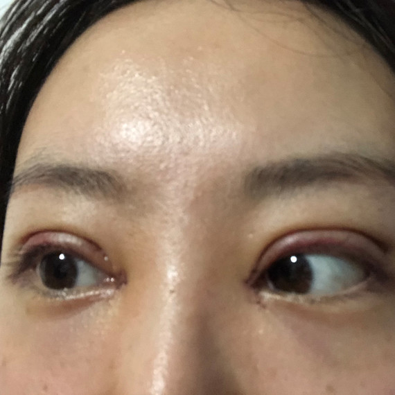 手术经过: 1,患者取仰卧位,常规消毒铺巾; 2,标记重睑线宽度距