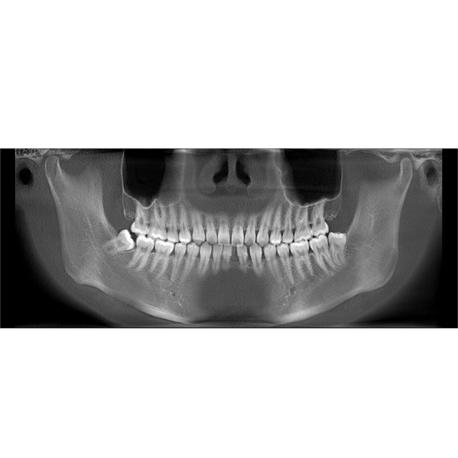 整齐的牙齿标准ct图片
