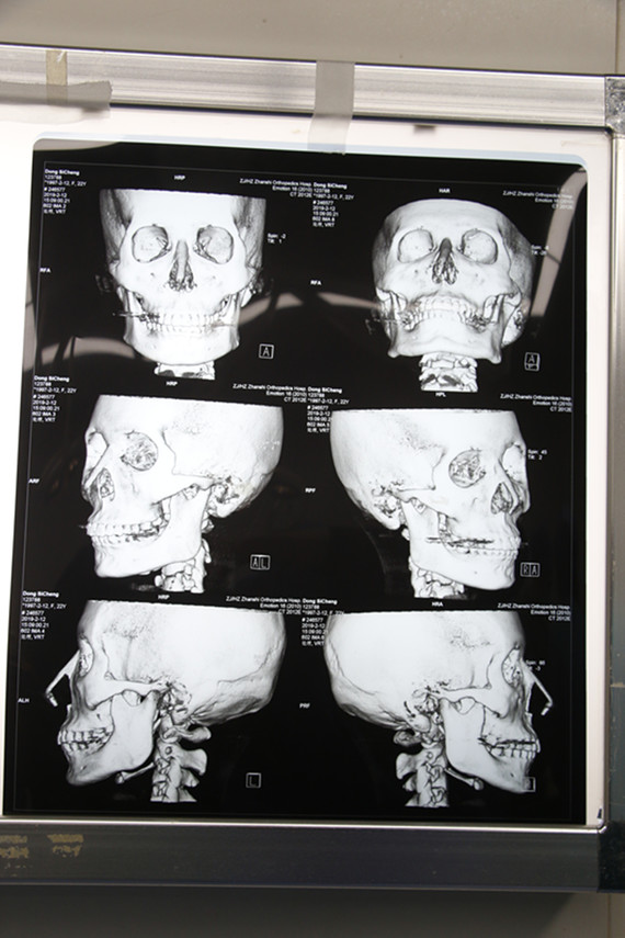 求美者脸型还是比较精致的,侧面看可以看到宽大的下颌骨,导致侧脸轮廓