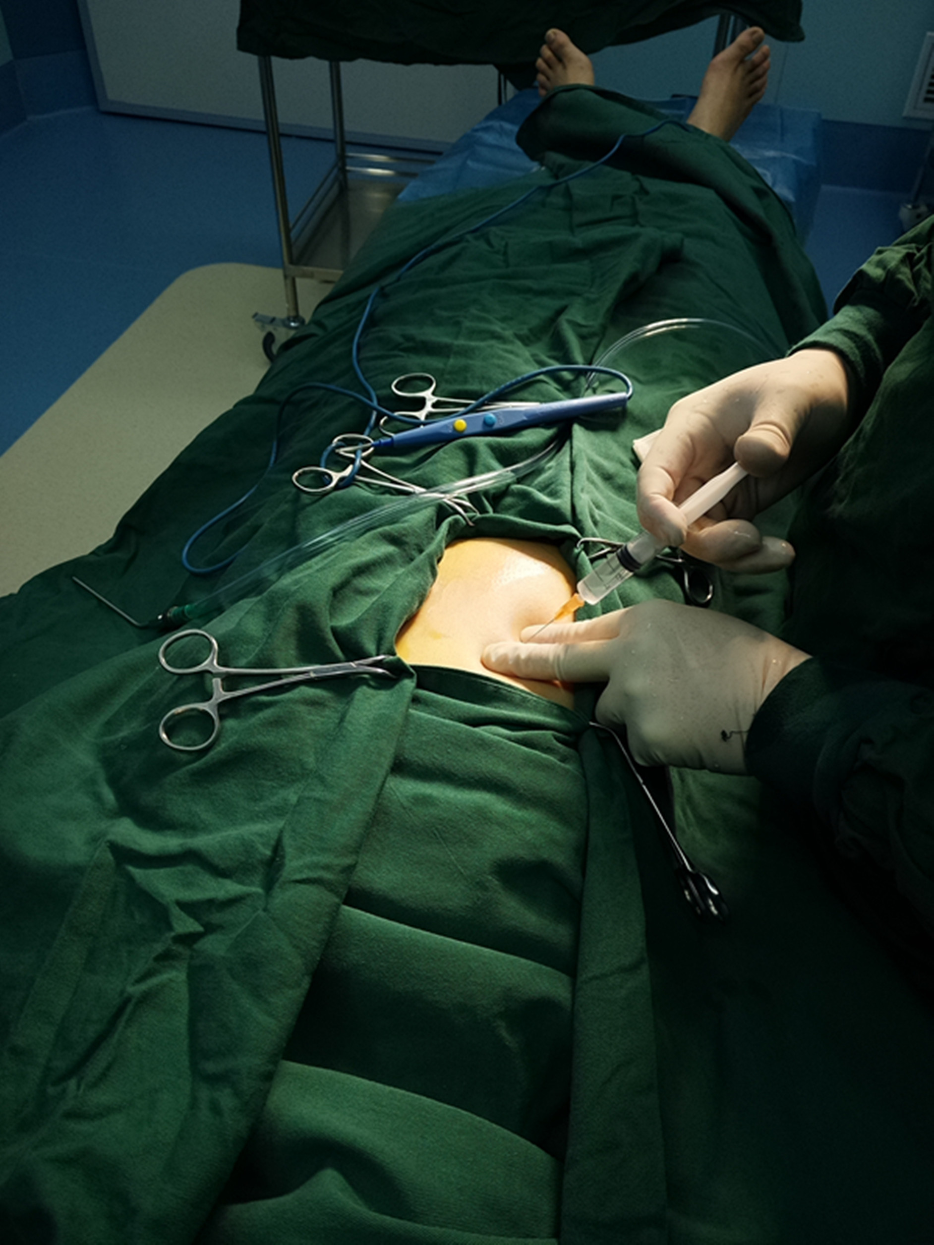 的刺激下,坚定了隆鼻的想法,最终选择朋友推荐的瑞俪医院做隆鼻手术