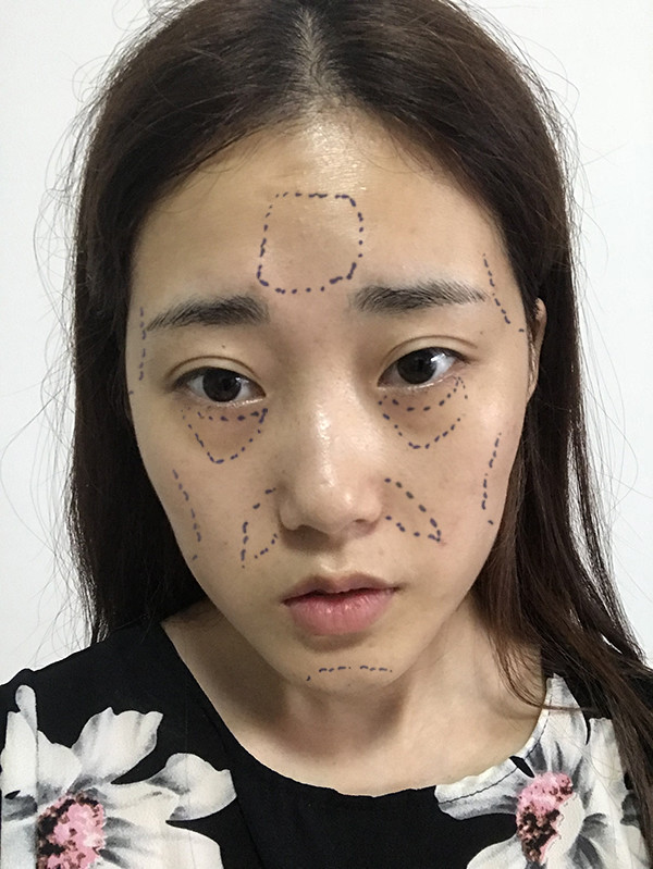 术前面部诊断报告: 1,额头扁平 2,太阳穴,苹果肌部位轻微凹陷 3,脸部
