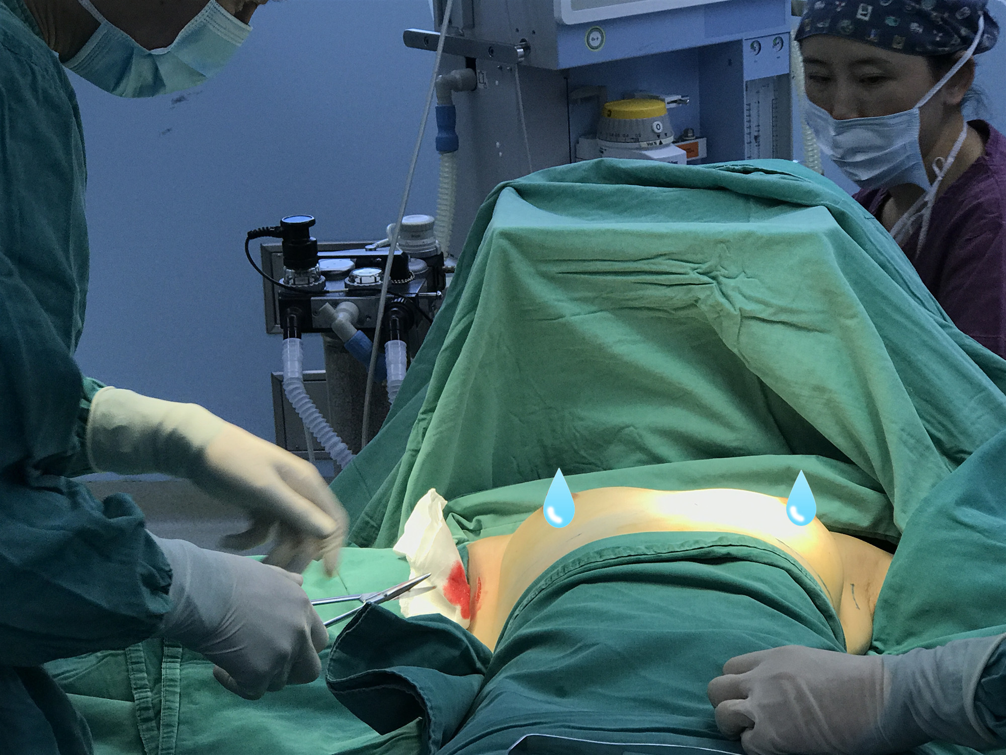 5,将消毒处理过后的假体,用两指内助从切口处