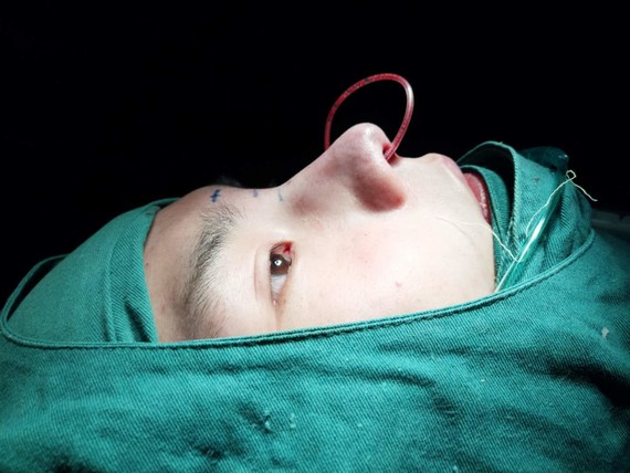 手术时长2 小时 术前照片术后照片报告亮点男生鼻根_圈子-新氧美容